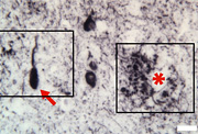 The toxic form of Elk-1 is present in plaque found in brain tissue from an Alzheimer disease patient (red asterisk). A neuronal process of a dying neuron is denoted by the red arrow. 